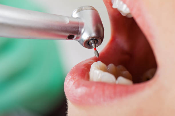 Best Emergency Wisdom Teeth Removal in Glenview, IL